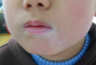 10岁孩子脸上的白癜风治疗
