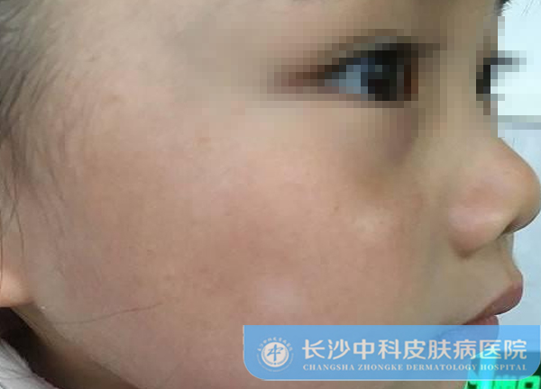 孩子脸上的白斑怎么治疗?