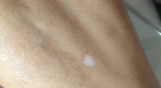 白癜风药物治疗的误区有哪些?