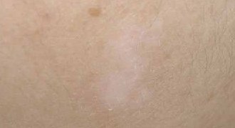 28岁女性白癜风要要多久才