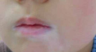 女孩嘴唇上有白斑，是因为涂口红造成的吗?